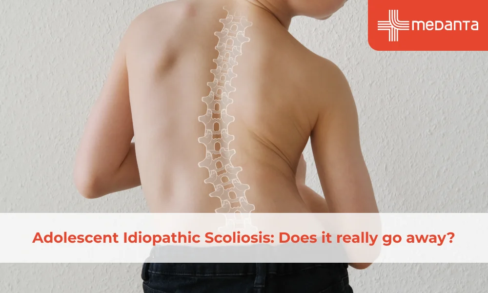 Adolescent Idiopathic Scoliosis: Does it really go away?