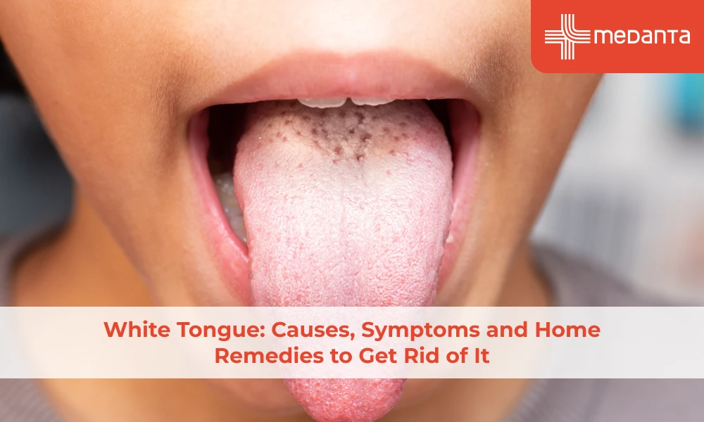 white-tongue-causes-symptoms-and-home-remedies-to-get-rid-of-it