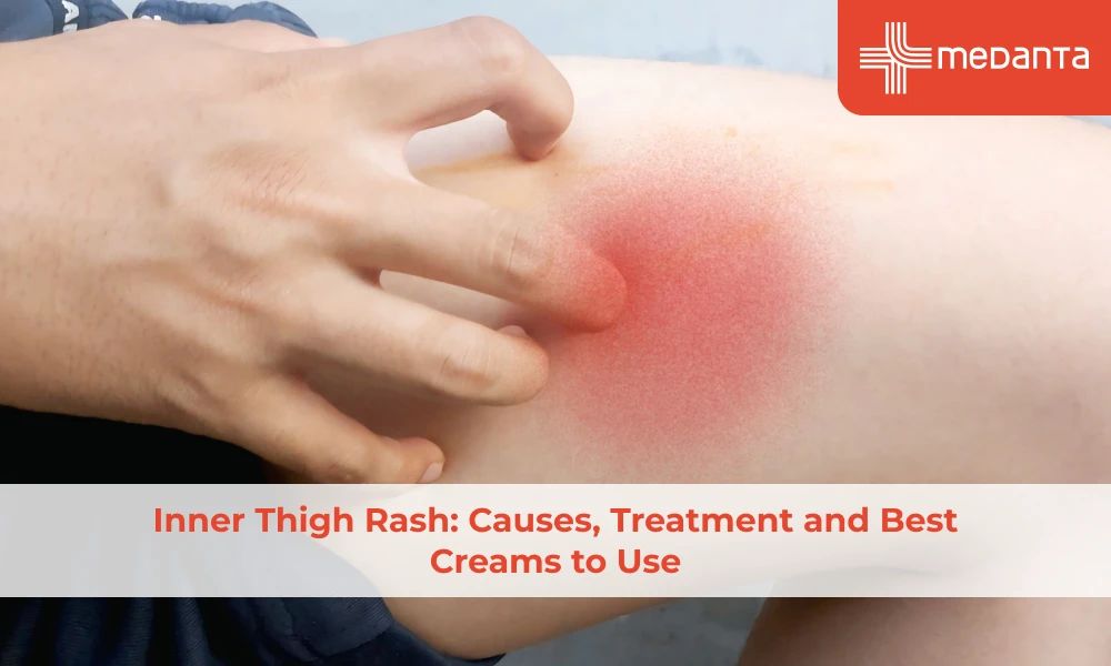 Inner Thigh Rash: Causes, Treatment and Best Creams to Use