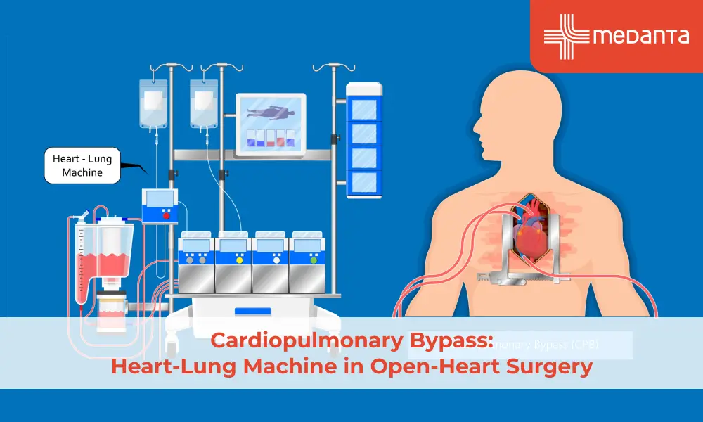 cardiopulmonary-bypass-heart-lung-machine-in-open-heart-surgery