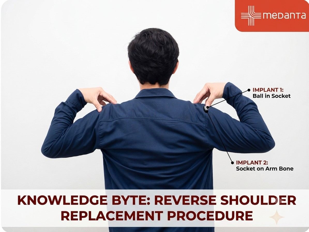 Knowledge Byte: Reverse Shoulder Replacement Procedure