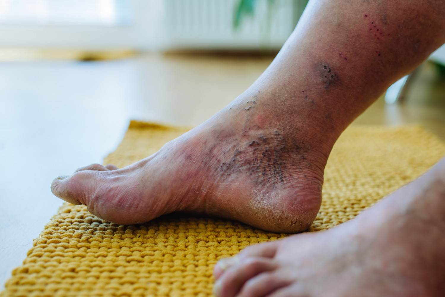 The Scary Truth About Diabetes Foot and Gangrene - Don't Wait Until It's Too Late!
