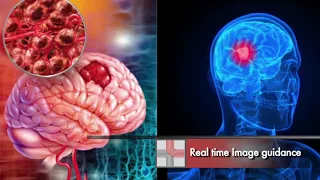 CyberKnife: Revolutionizing Tumor Treatment in India