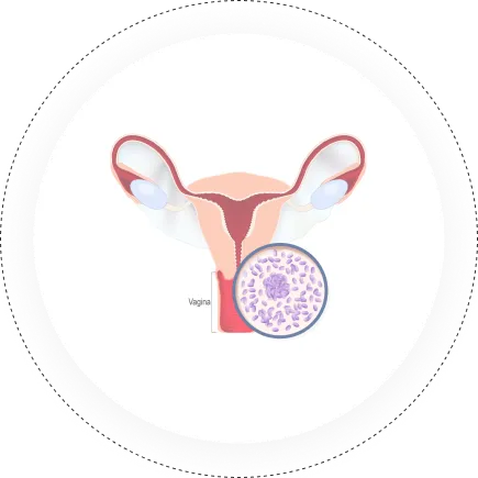 Gynae-Oncology