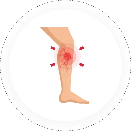 Peripheral Vascular and Endovascular Sciences