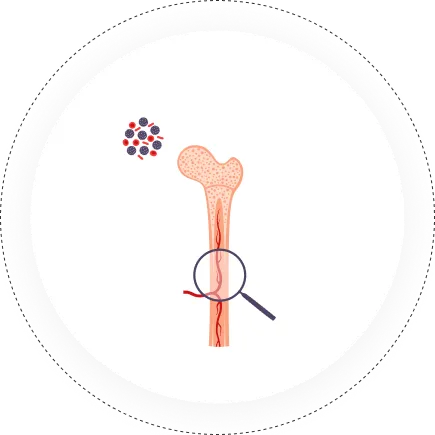Bone Marrow Transplant