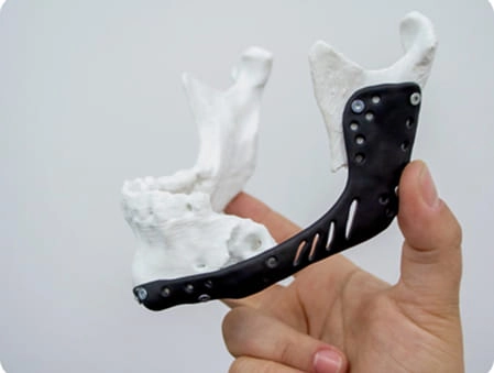 Customised 3D titanium implants useful for complex orthopaedic reconstruction surgery
