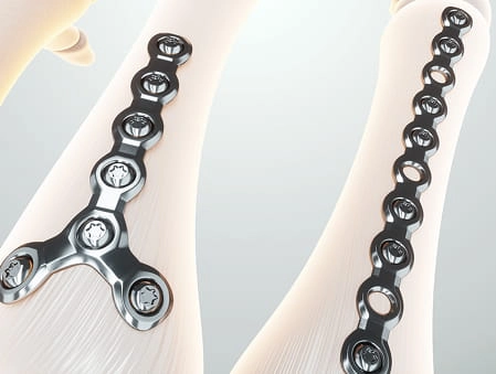Synthes Plating System