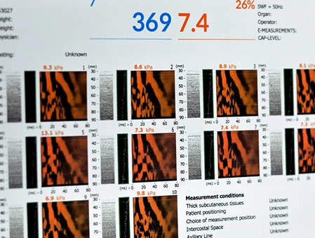 Fibroscan