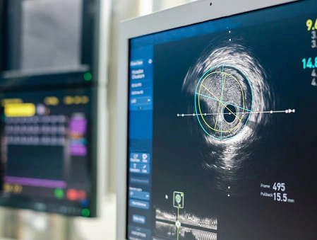 IVUS (Intravascular Ultrasound)