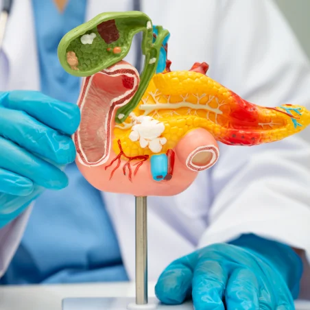 Gallstones and Bile duct stones