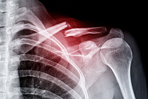 Severe Bone Fracture
