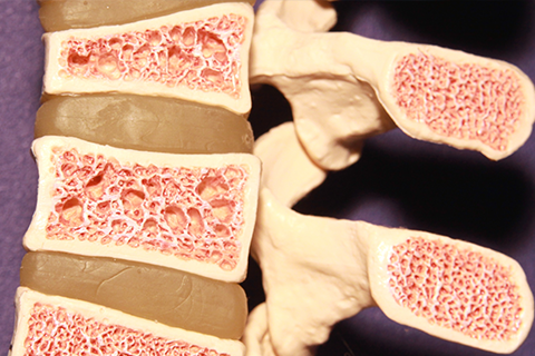 osteoporosis