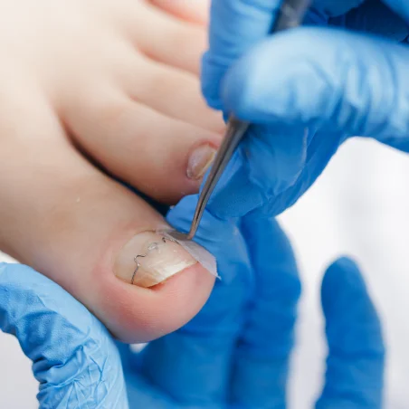 Nail Surgeries