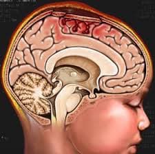 Head Trauma 