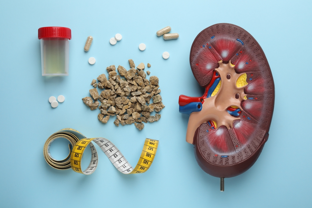 Kidney Stones