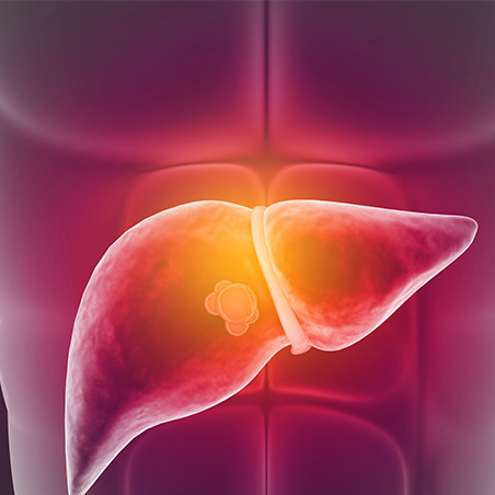 Liver Cancer or Hepatocellular Carcinoma