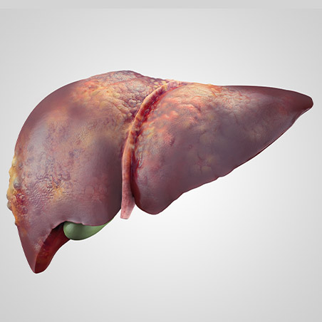 Liver Cirrhosis