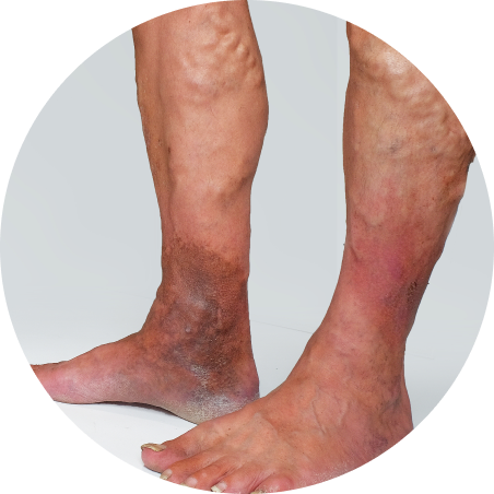 Peripheral Vascular Disease