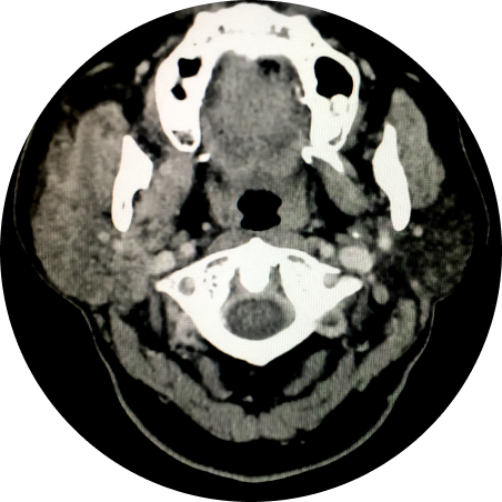 Parotid and Thyroid Tumours