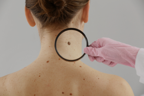 Melanoma