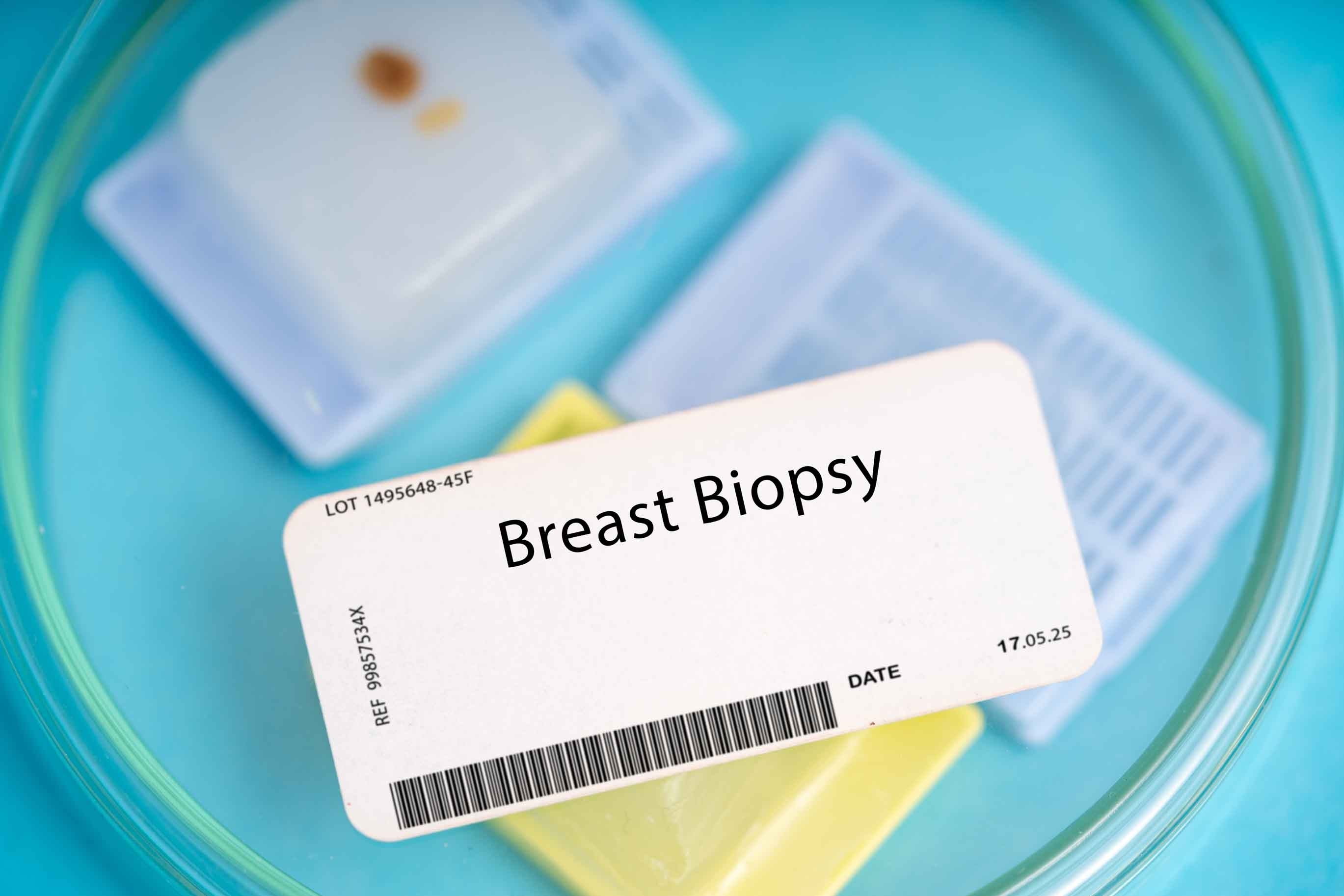 Breast Biopsy