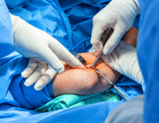 Complex Open Thoracic Surgery